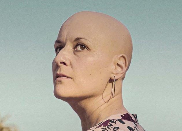 "Mujeres calvas": sí, la alopecia también afecta a las&nbsp;mujeres